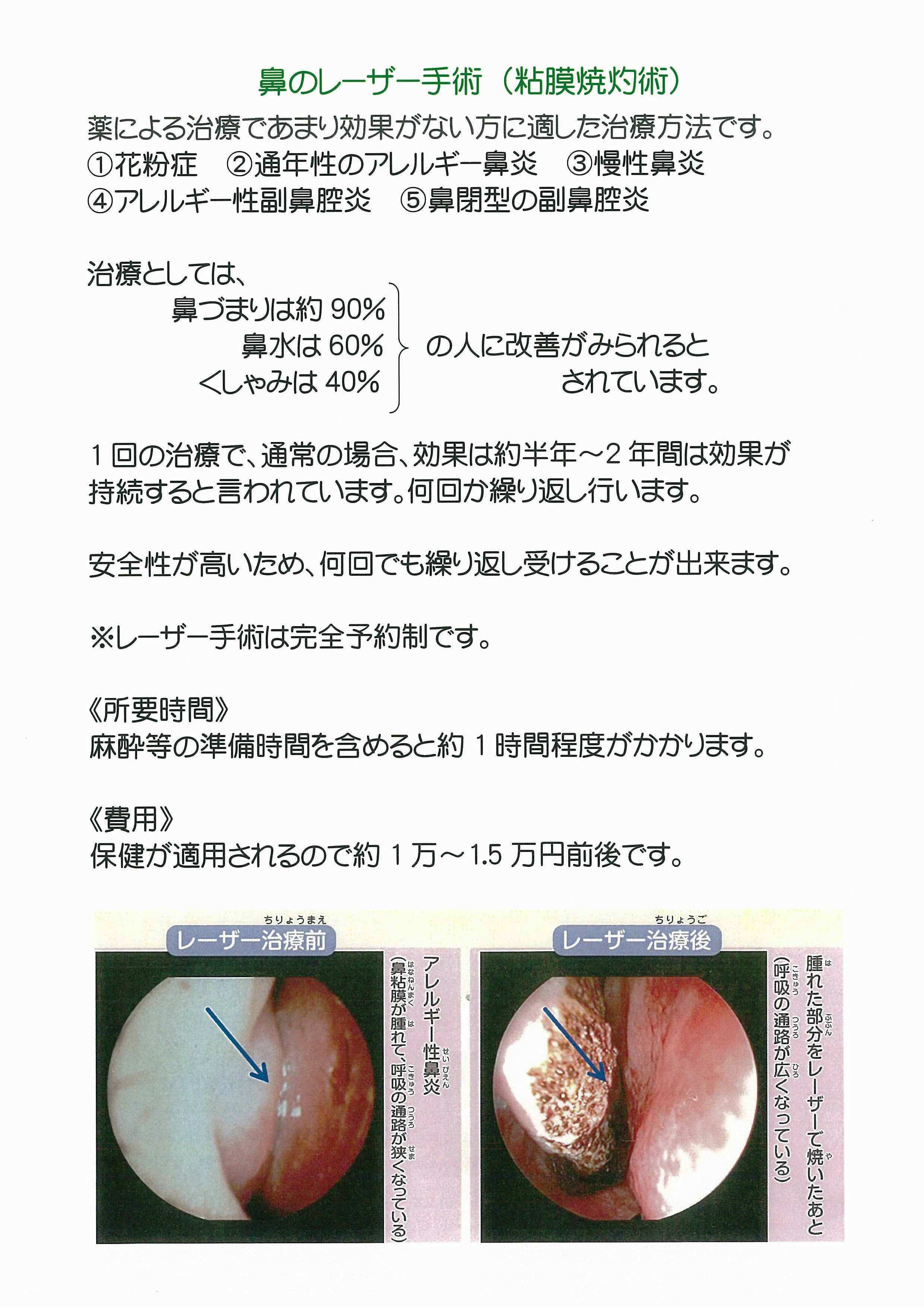 手術 費用 いびき